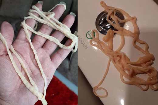 Man Left Horrified After He Pulls Out 32 Feet Tapeworm From His Body In