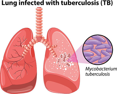 tuberculosis22...