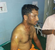 Acid Attack in Belthangady, Victim suffers serious burns.