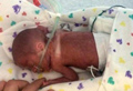1.5 Pound ’Miracle’ Preemie’ is born on a cruise ship