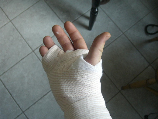 hand fracture