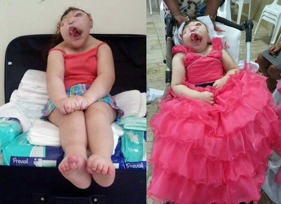 Girl born with no face defies all the odds and celebrates her ninth birthday
