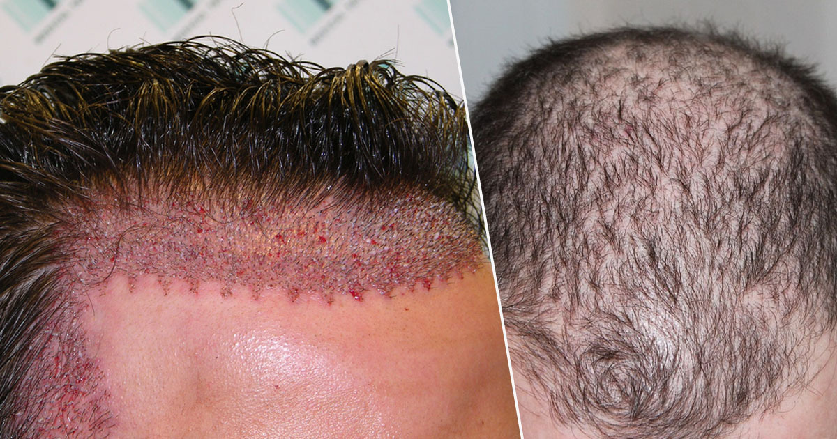 10 Hair Transplant Side Effects that You Should Be Aware Of  Updated 2023   Credihealth