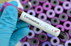 17 fresh Covid-19 cases in DK on Sunday