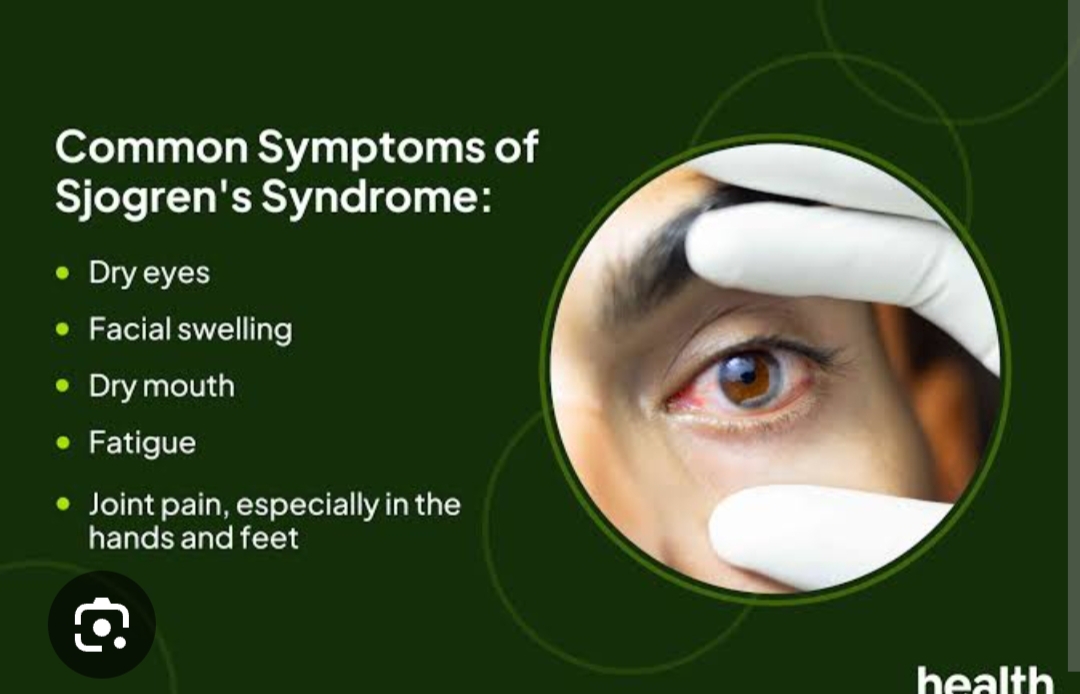 Living With Sjogren Syndrome: When Dryness Is Only the Beginning