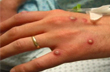 UAE reports 3 more Monkeypox cases