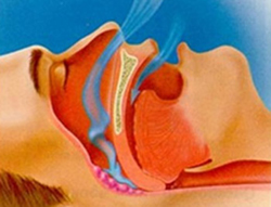 Obstructive Sleep Apnea